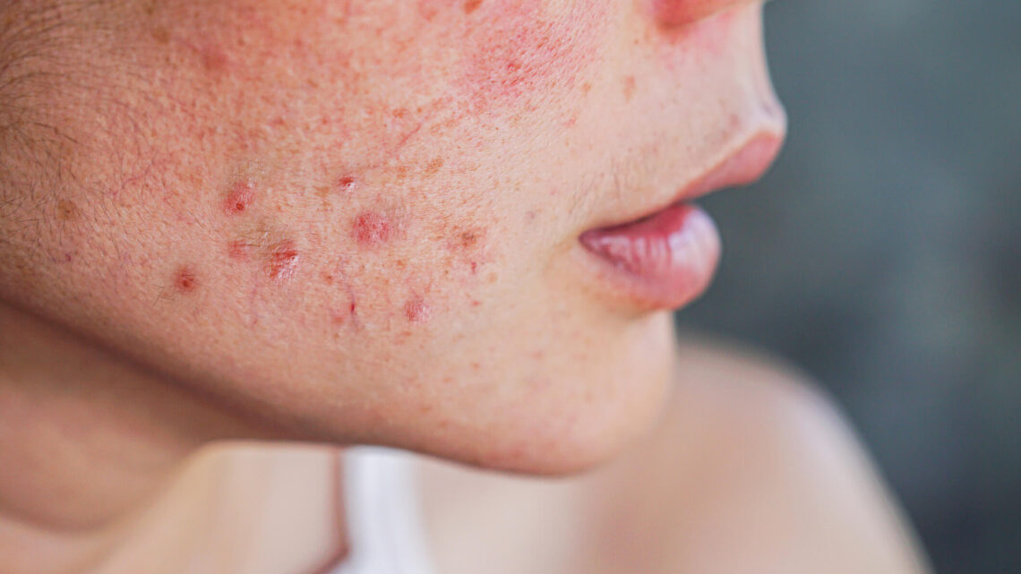 Qu’est-ce que l’acné ?
